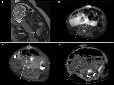 Klippel–Trénaunay syndrome with profound abdominal lymphatic-venous malformation in a three-day-old newborn: a case report and literature review